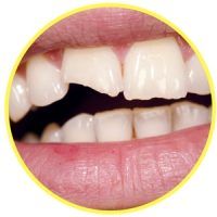 Chipped or Broken Tooth chipped or broken tooth image
