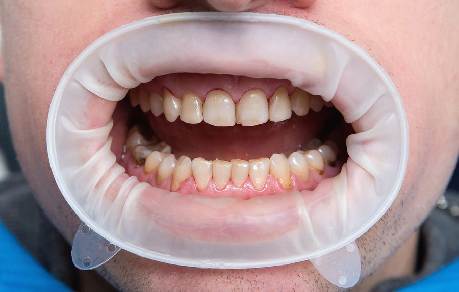 Expander Teeth