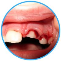 Knocked Out Teeth knocked out teeth image