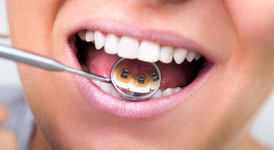 Lingual Braces