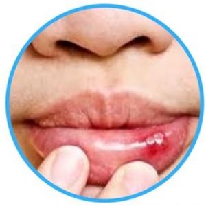 Lips Injury lips injury image