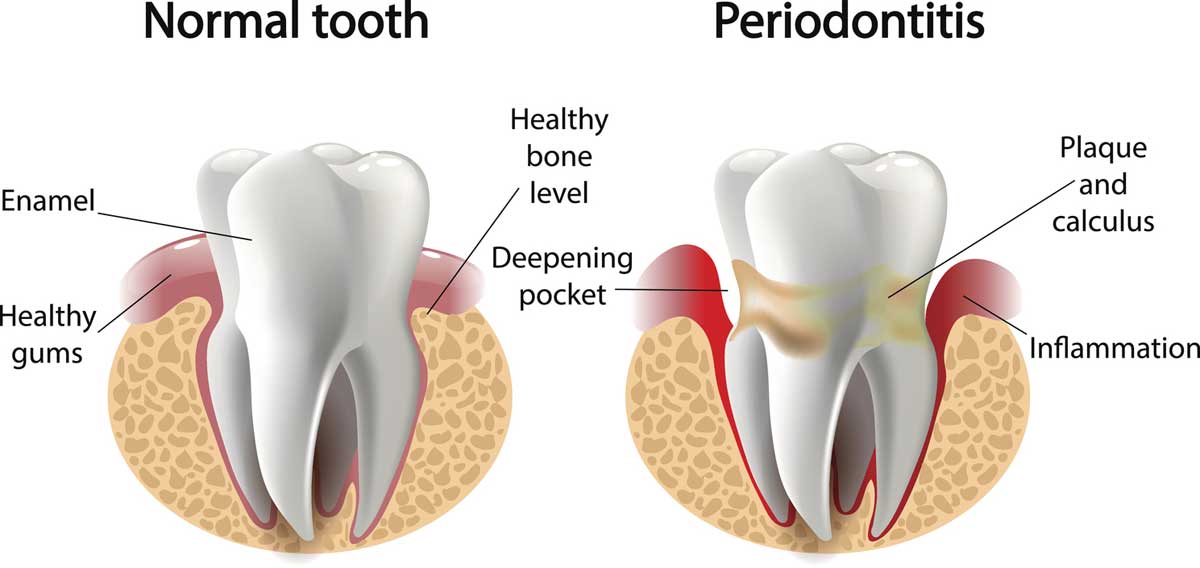Periodontal Disease Stages Periodontal Disease Stages