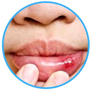 Soft Tissue Injuries soft tissue injuries image